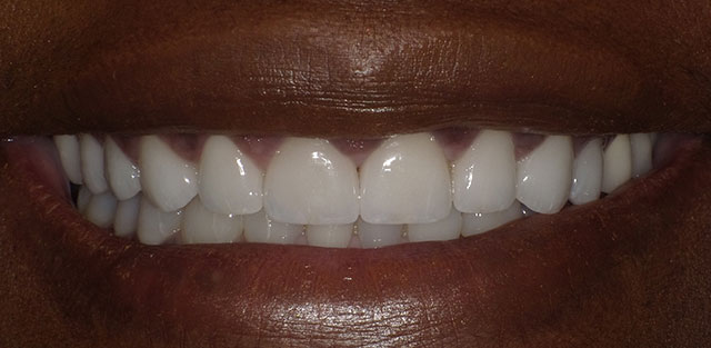 lesley-teeth5
