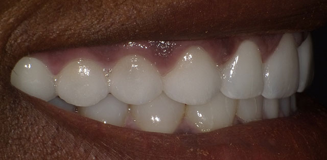 lesley-teeth1