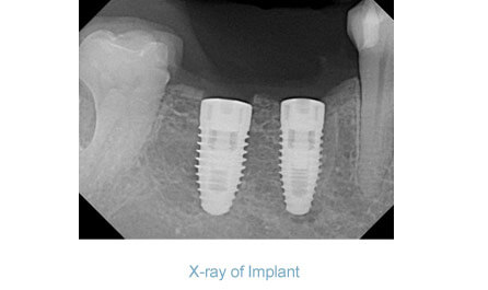 implant_ex_xray