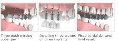 Implant Example