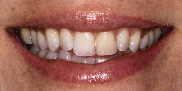emily-teeth1-before