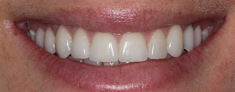 gerri-teeth1-after