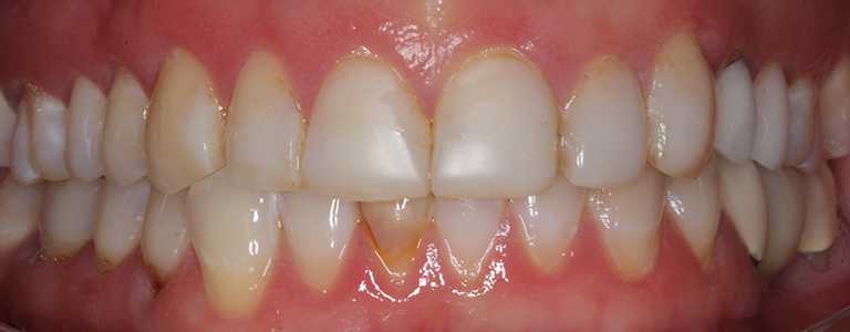 gerri-teeth1-before