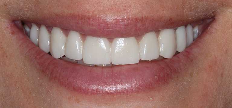 gerri-teeth2-after