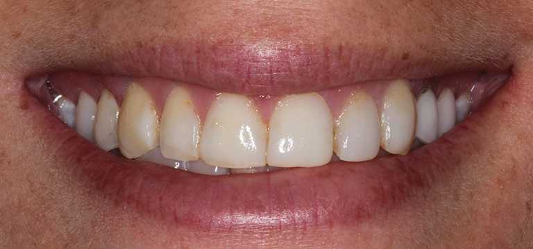 gerri-teeth2-before