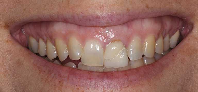 holly-teeth1-before