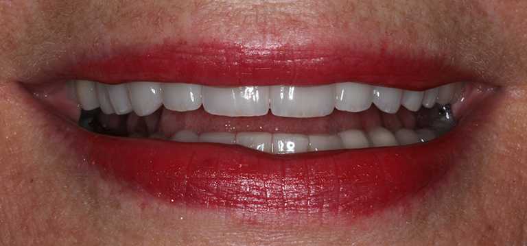 jane-teeth1-after