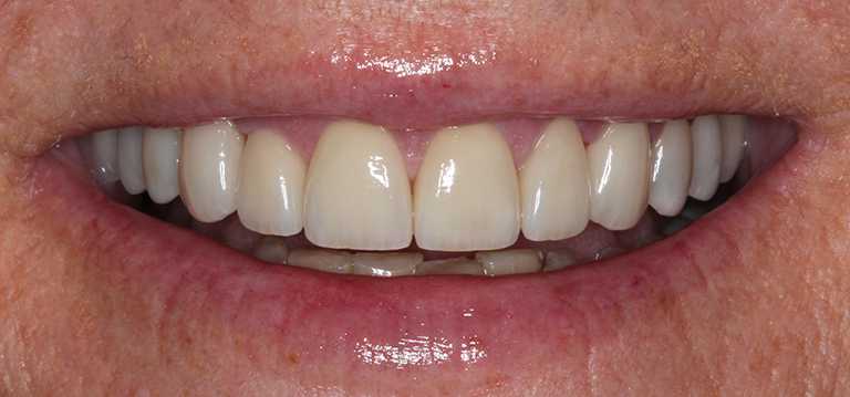 kathleen-teeth1-after