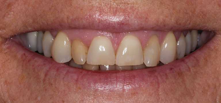 kathleen-teeth1-before