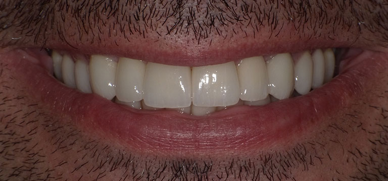 lyor-front-teeth-after