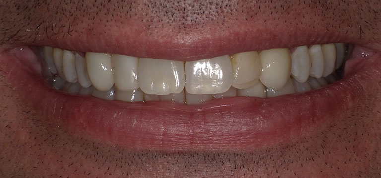 lyor-front-teeth-before