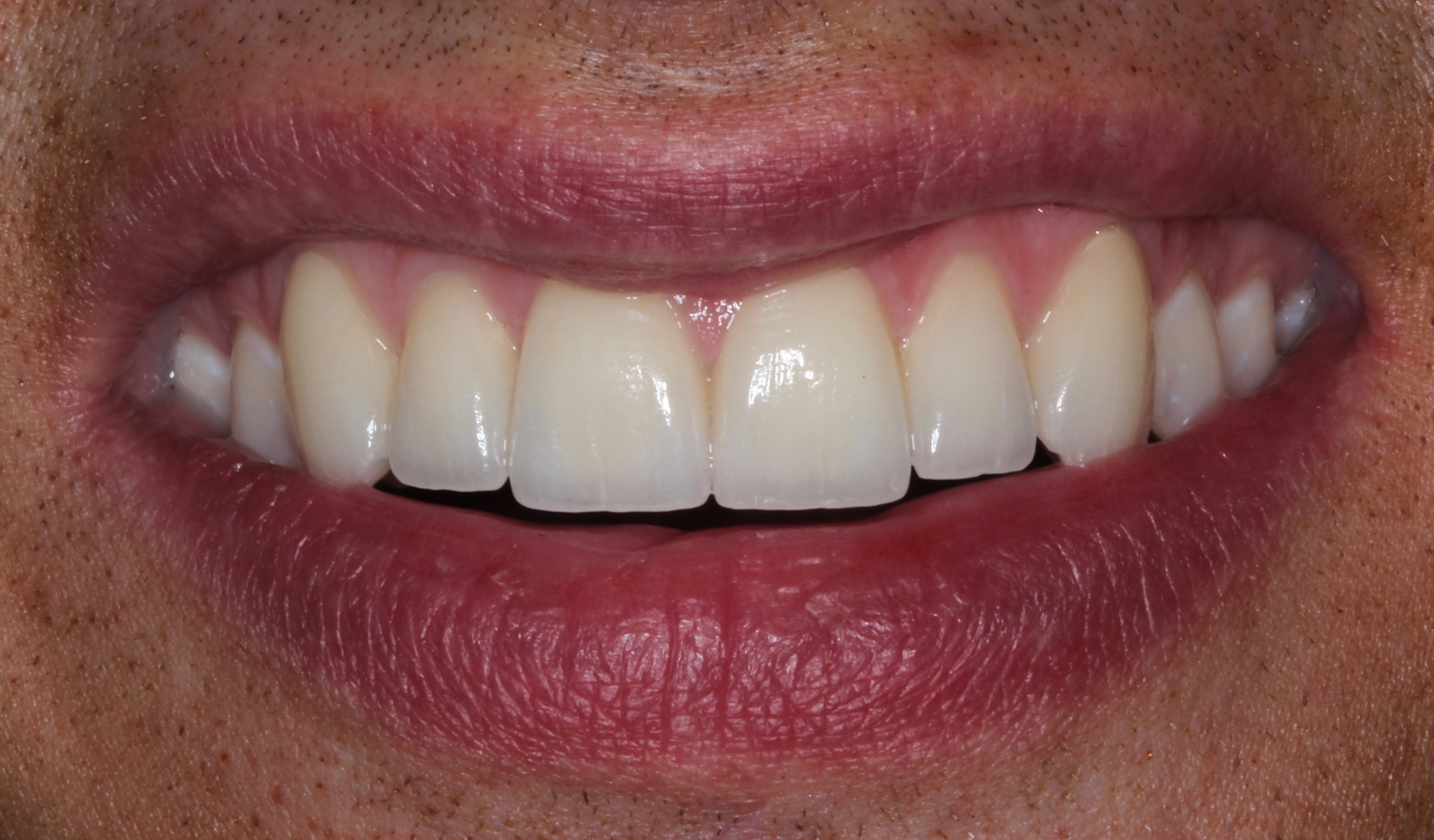 clayton-teeth5