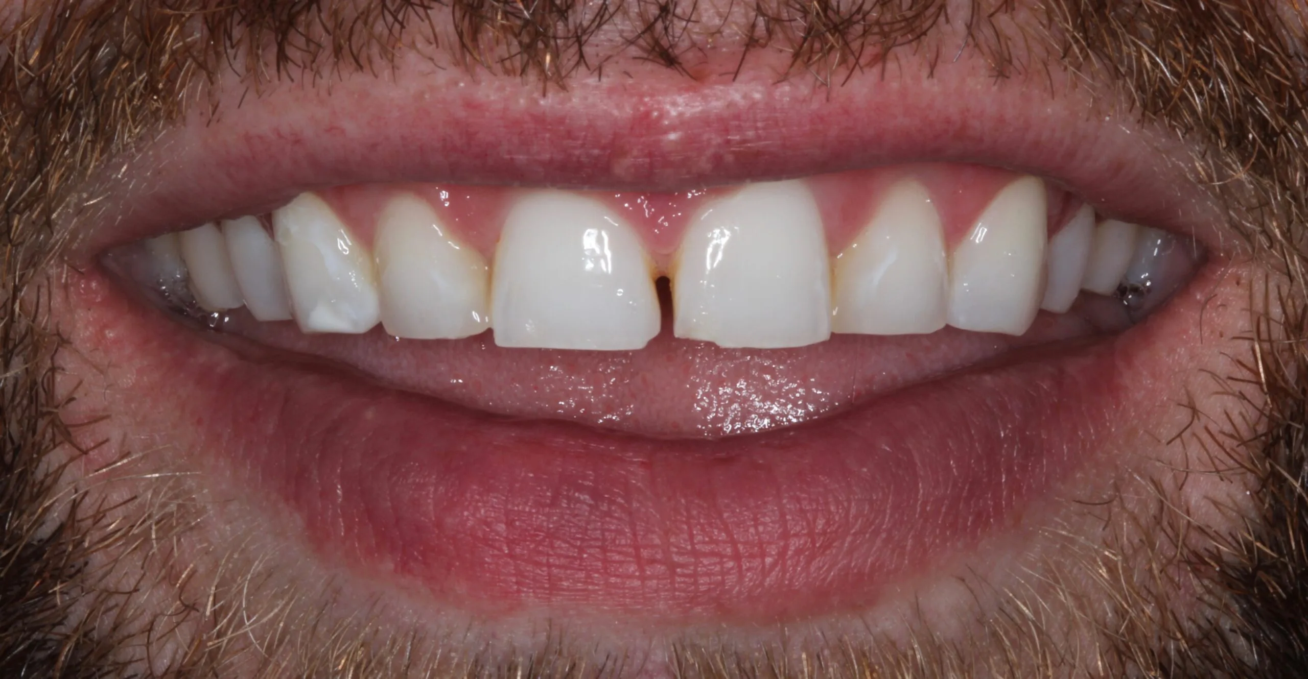Andrew Before