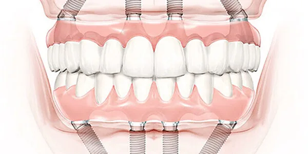 Dental-Implant