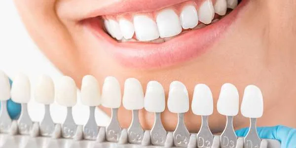 Veneers