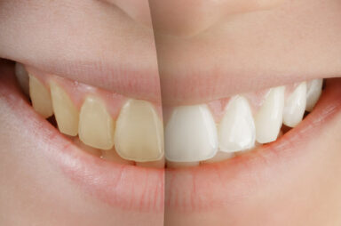 Dental Veneers in NYC