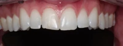 Elite-Before