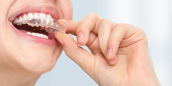 Invisalign-Treatment