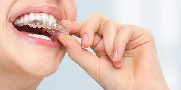 Invisalign-Treatment