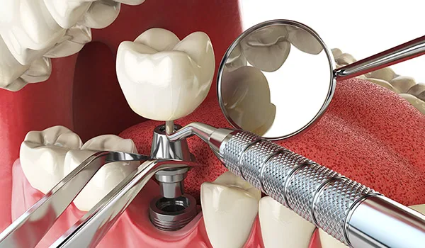 Low-Cost-Dental