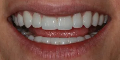 Veneers