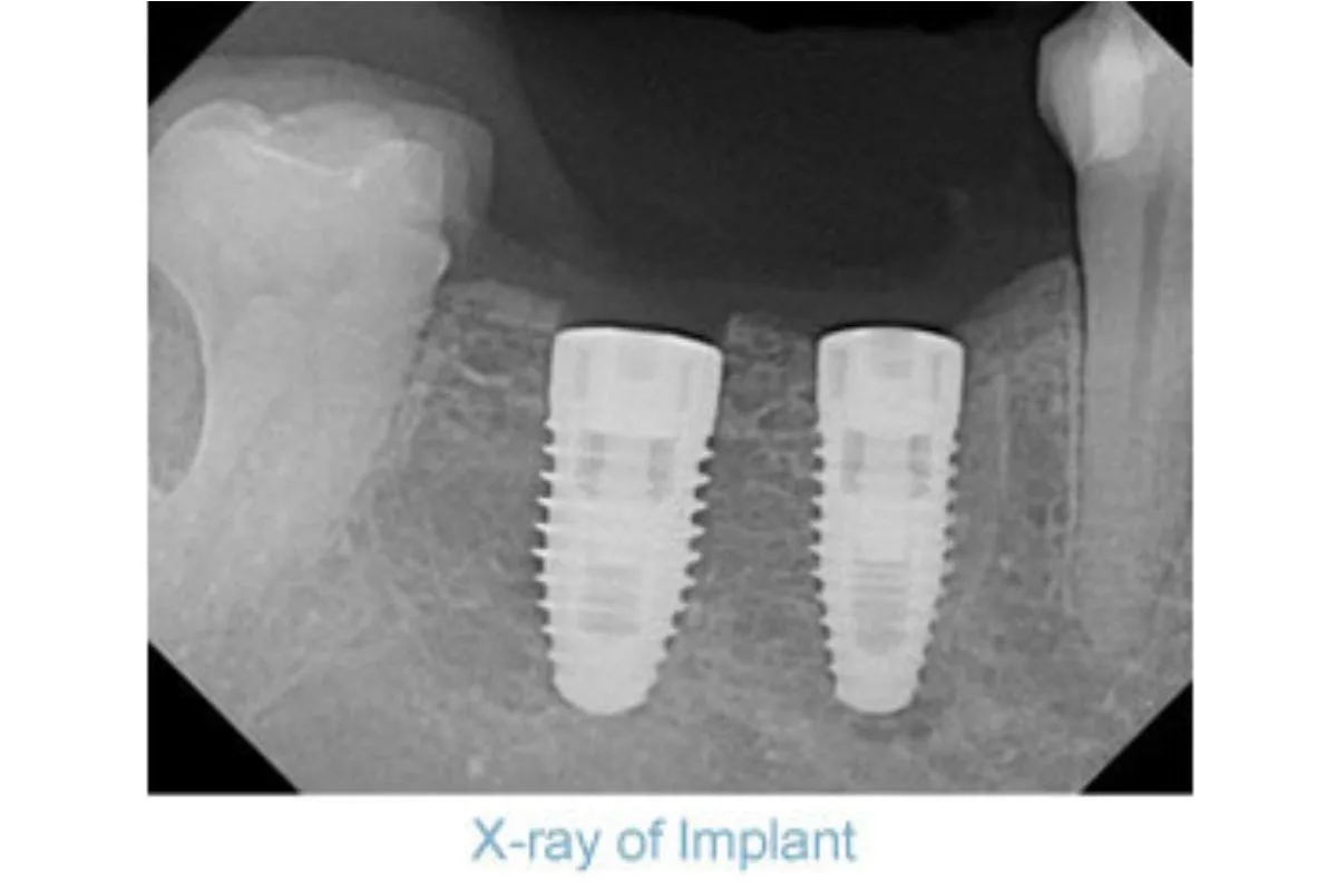 X-ray