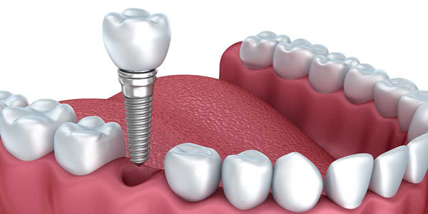 dentalimplant