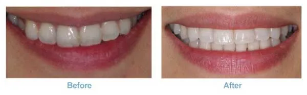 invisalign_ex