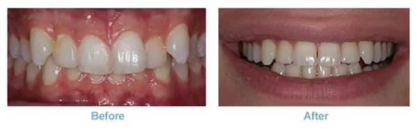 invisalign