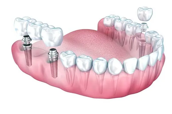 permanent-tooth