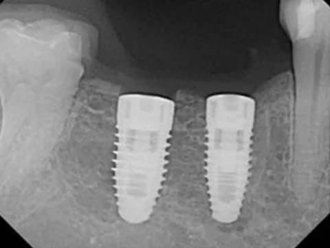 Implants