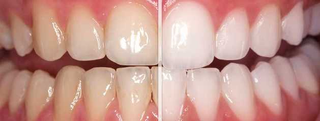whitening